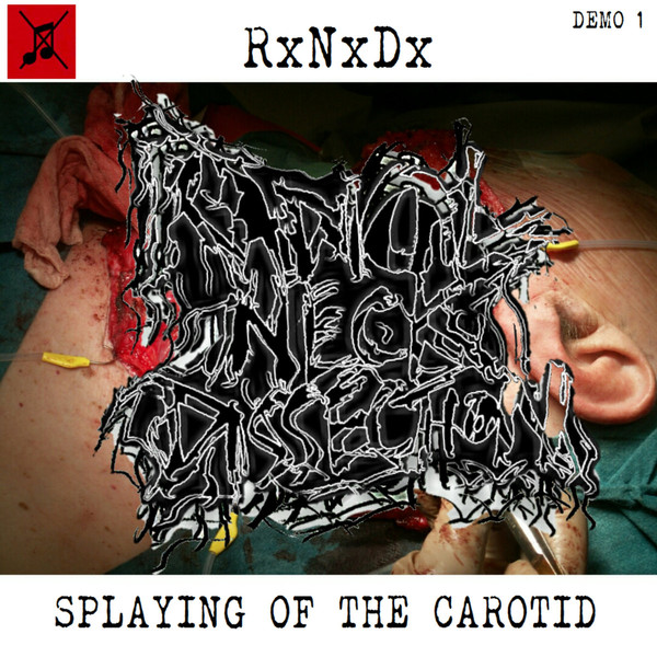 RADICAL NECK DISSECTION - "SPLAYING OF THE CAROTID: DEMO 1"